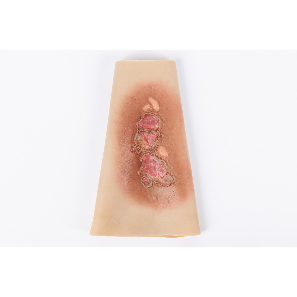 TRAUMASIM Wearable Small Burn - Forearm Image
